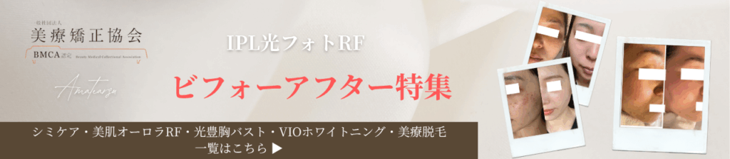 AMATERASUシミケア,業務用脱毛機,高機能,スペック,機器詳細,効果,症例,実績,ビフォーアフター,BeforeAfter,IPL機器